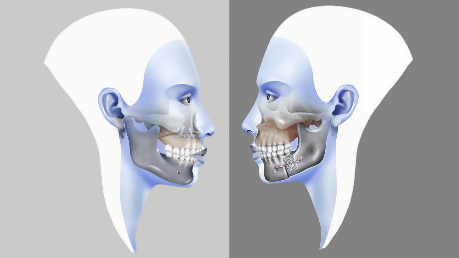 Ortognatik Cerrahi,Kadıköy Ortognatik Cerrahi,Ortodontik tedaviler,Kadıköy OPC Ortognatik Cerrahi,çene ameliyatı,Surgery First (SFA) ile Ortognatik Cerrahi
