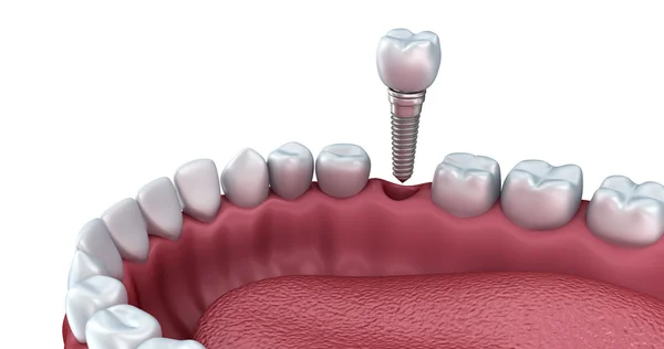 depositphotos 88534218 stock photo 3d lower teeth and dental