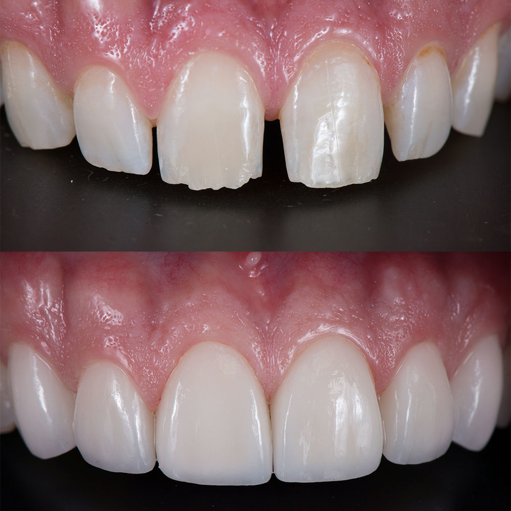 correction,of,spacing,teeth,with,dental,ceramic,veneers,,before,and