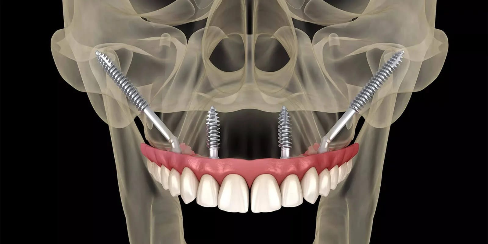 zigoma implant antalya mrv dental
