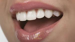 how is smile design done in kadıköy