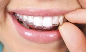 how long does clear aligner treatment take in kadıköy
