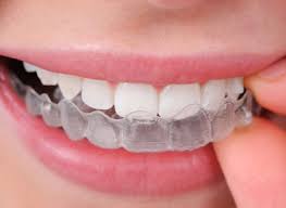 how to straighten teeth with invisalign in kadıköy