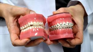 in kadıköy for orthodontic treatment, should we use aligners or braces