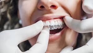 kadıköy clear aligner treatment stages