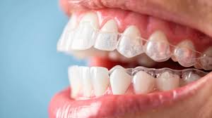 kadıköy invisalign planning process