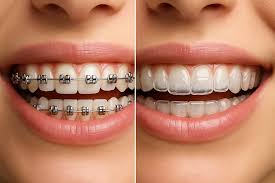 things to consider after getting clear plate installation in kadıköy
