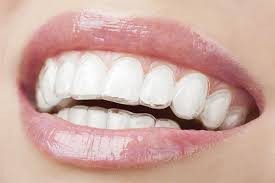 things to know before invisalign treatment in kadıköy