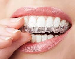 what are the tooth alignment methods in kadıköy