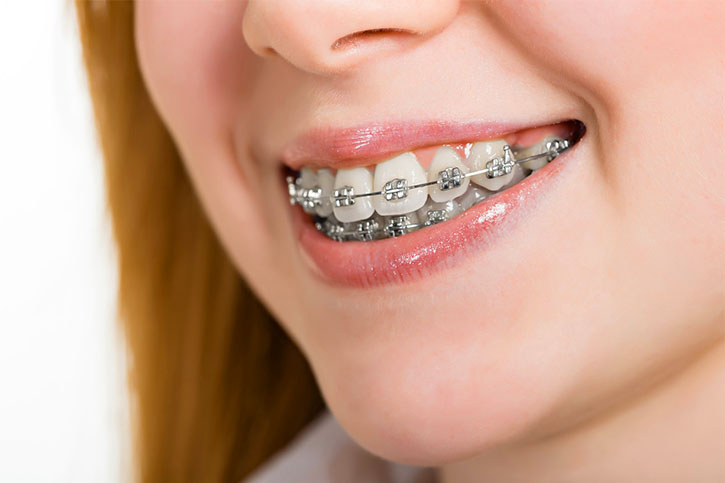 teeth and braces.