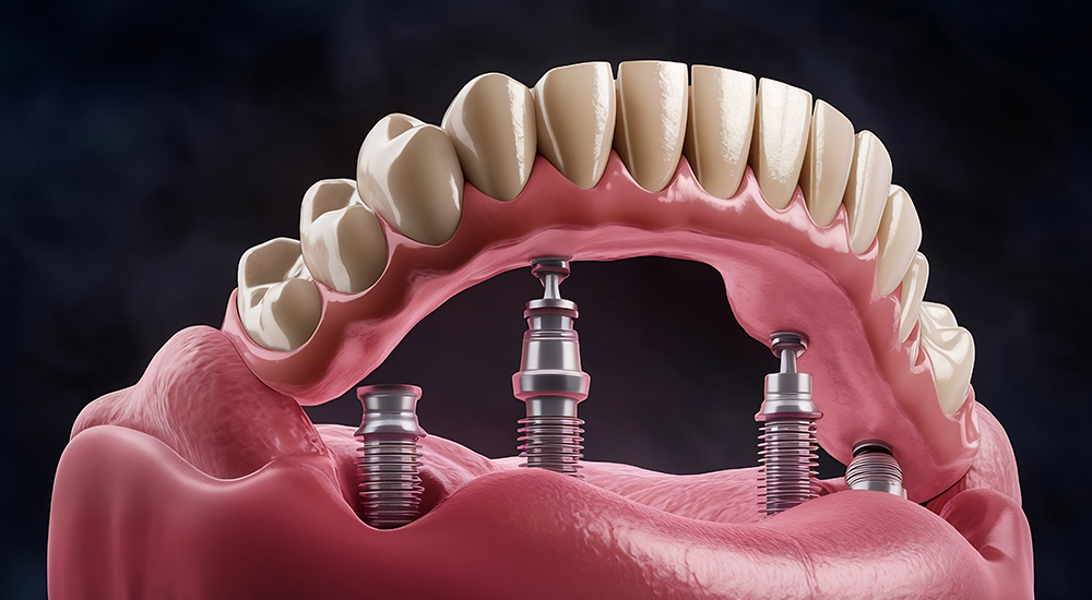 all on four implant (1)